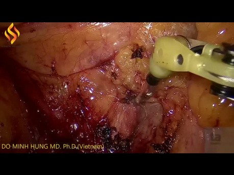 Laparoscopic Lymphadenectomy for Right Colon Cancer