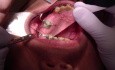 Molar Intrusion - The Invisible Becomes Visible (Clinical)