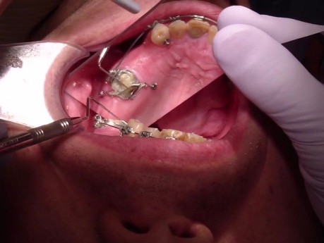 Molar Intrusion - The Invisible Becomes Visible (Clinical)