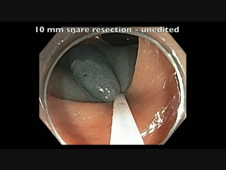 Transverse Colon - Subtle Lesion EMR