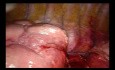 Uniportal VATS anatomic right segmentectomy S6 (NON EDITED SURGERY)