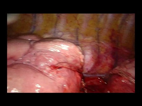 Uniportal VATS anatomic right segmentectomy S6 (NON EDITED SURGERY)