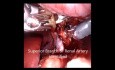 Robot Assisted Radical Nephrectomy for Wilm's Tumour