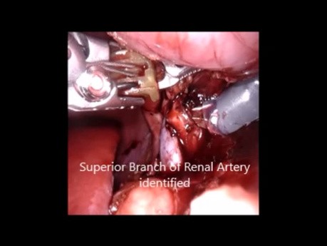 Robot Assisted Radical Nephrectomy for Wilm's Tumour