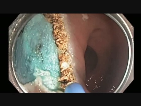 Colonoscopy - Rectal Flat Lesion - EMR