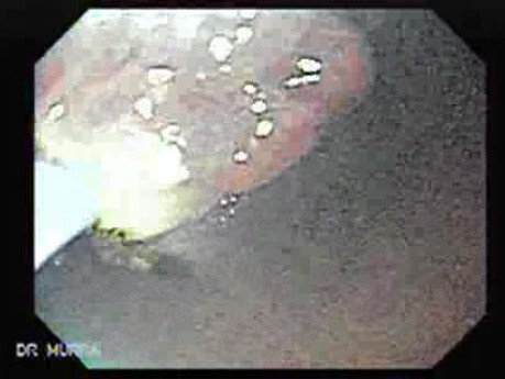 Multilobulated Gastric Polyp (11 of 20)