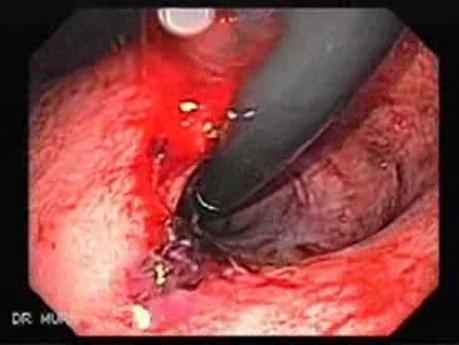 Endoscopy of Mallory Weiss Tear - Lacerations at the Cardias