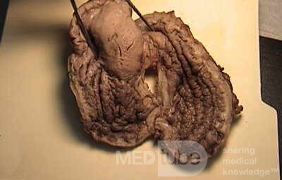 Plastic Linitis with bilateral Krukenberg´s tumor (4 of 13)