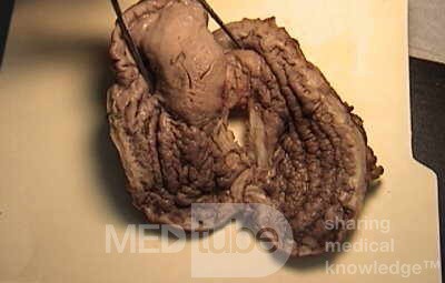 Plastic Linitis with bilateral Krukenberg´s tumor (4 of 13)