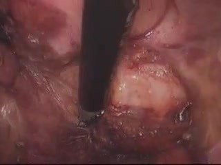 Laparoscopic Abdominoperineal Resection 