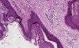 Fibroepithelial polyp (skin tag)