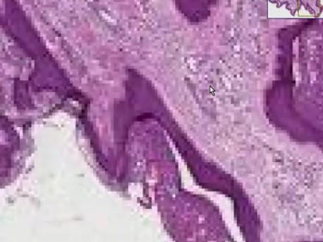 Fibroepithelial polyp (skin tag)