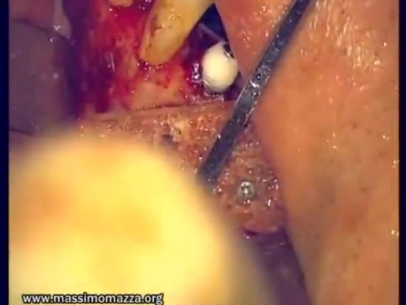 Regeneration Of Multialveolar Process (Right-Side) (1/3)
