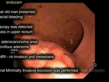 TransAnal Minimally İnvasive Surgery (TAMIS) for T1 Malignant Adenoma of the Proximal Rectum 