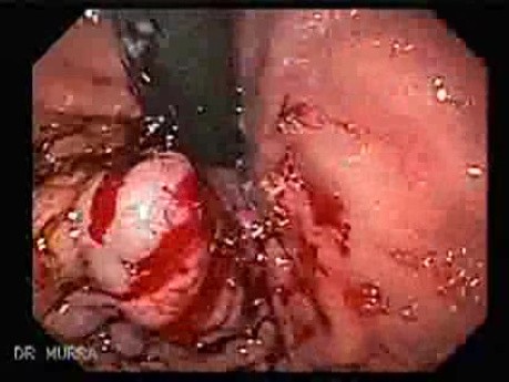 Gastric Varices - Endoscopic Ablation With Cyanoacrylate Glue (2 of 18)