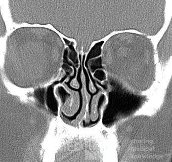 Maxillary Sinus Hypoplasia Type 1 [CT scan]