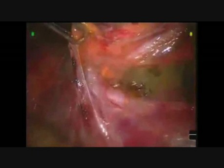 Robotic Hand Assisted Left Donor Nephrectomy