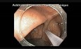 Cancer Of Ascending Colon: Biopsy And Marking For Surgery
