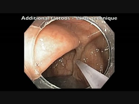 Cancer Of Ascending Colon: Biopsy And Marking For Surgery