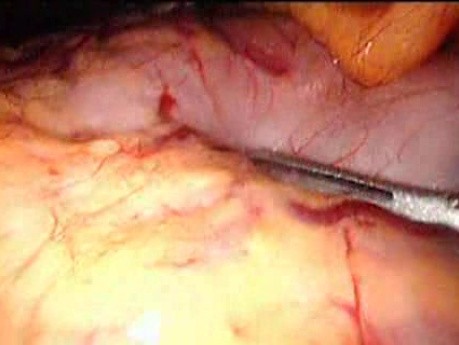 Gastrointestinal Stromal Tumor - GIST (14 of 65)
