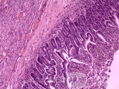 Jejunal Gastrointestinal Stromal tumor (GIST) (11 of 86)