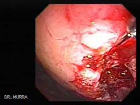 Abdominal Compartment Syndrome due to Malignancy (8 of 10)