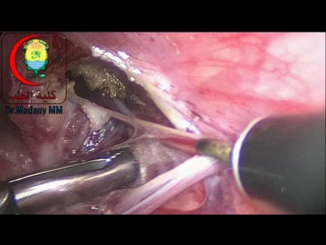 Disconnection Of The Sac Difficult Part Is The Medial