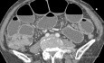 Right Colon Tumor with Small Bowel Obstruction