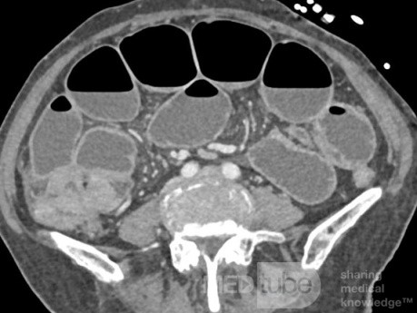 Right Colon Tumor with Small Bowel Obstruction