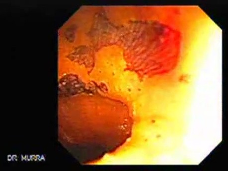 Barrett's Esophagus of long segment (19 of 24)