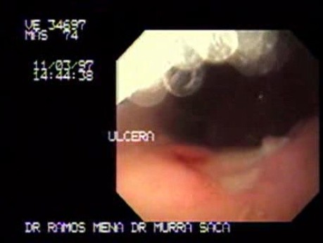 Gastric Ulcer