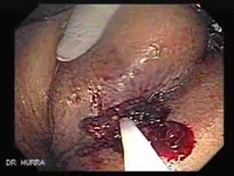 Endoscopic Resection of Giant Tubulo-Villous of the rectum (6 of 35)