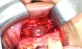 Apical Cyst