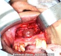 Apical Cyst