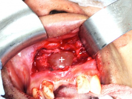 Apical Cyst
