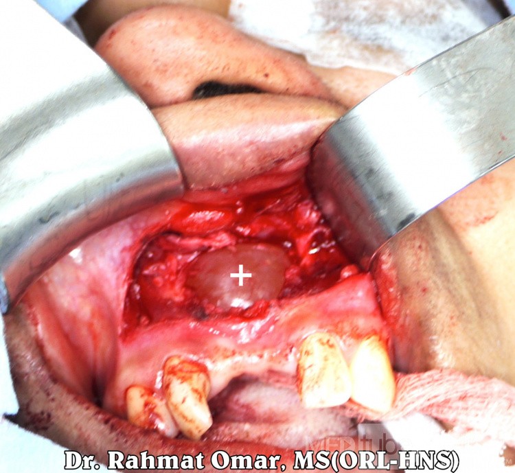 Apical Cyst