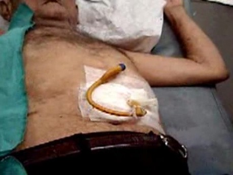 Percutaneous Endoscopic Gastrostomy - Outer View