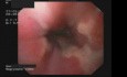 Esophagitis