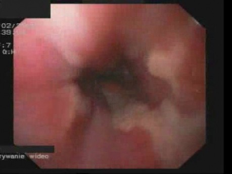 Esophagitis