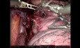 Robotic Right Upper Sleeve Resection and Azygus Flap