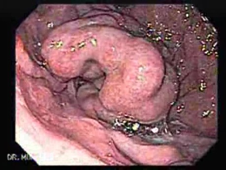 Gastric Varices (1 of 25)