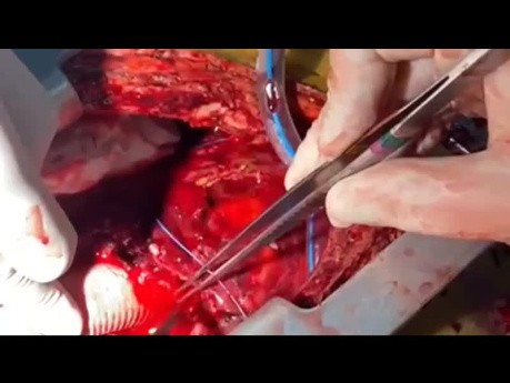 Redo RCA Operation in Bleeding of Bental 