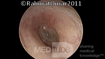 Thickened Eardrum