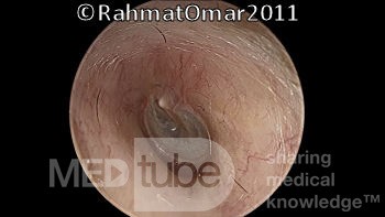 Thickened Eardrum
