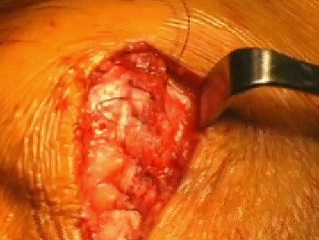 Tissue Closure of a Uni-compartmental Knee Arthroplasty by Dr Keith R Berend