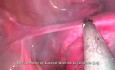 SILS Total Hysterectomy 