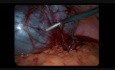 Laparoscopic Huge Paratubal Cystectomy