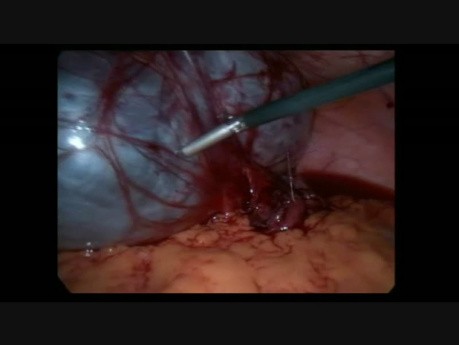 Laparoscopic Huge Paratubal Cystectomy