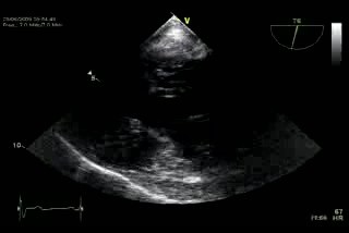 Mitral Valve Regurgitation