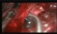 Live Thoracoscopic Surgery Complex VATS Middle Lobectomy due to Hilar Calcified Lymph Nodes